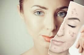 Reemplazo de Botox
