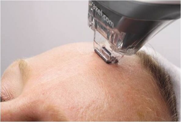procedimiento de peeling para el rejuvenecimiento de la piel del rostro